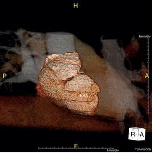 CT scan: three-dimensional reconstruction of the right atrial aneurysm (RAA).