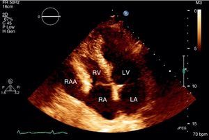 Transthoracic echocardiogram, apical 4-chamber view. LA: left atrium; LV: left ventricle; RA: right atrium; RAA: right atrial aneurysm; RV: right ventricle.