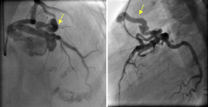 Imagem angiográfica da fístula (seta amarela), com origem no segmento proximal da artéria descendente anterior e drenagem na artéria pulmonar; à esquerda, projeção cranial oblíqua direita; à direita, projeção de perfil.