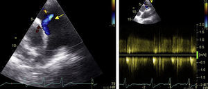 Ecocardiograma transtorácico (plano paraesternal, eixo curto): à esquerda, com Doppler cor visualiza‐se fluxo laminar a drenar na região proximal do tronco da artéria pulmonar (seta amarela); observa‐se ainda pequeno fluxo de insuficiência pulmonar. À direita, Doppler contínuo revela que se trata de um fluxo sistodiastólico, com predomínio diastólico e com velocidade máxima de 1,0m/s.