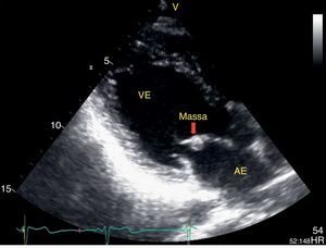 Ecocardiograma transtorácico em paraesternal longitudinal onde se visualiza pequena massa bem definida aderente ao folheto anterior da válvula mitral.