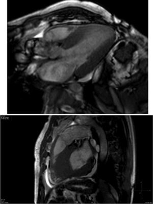 Cardiovascular magnetic resonance showing concentric left ventricular hypertrophy and increased right ventricular free wall thickness, with decreased left ventricular volume.