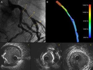 Coronary angiography showing a significant lesion in the proximal left anterior descending (LAD) artery (A). IVUS images show the LAD ostium without significant lumen involvement and an eccentric calcified lesion (1); in the mid segment a concentric lesion with severe calcification is visible (2), and the distal segment has a fibrous, concentric, non-significant plaque (3); (B) 3D IVUS reconstruction of the LAD with pressure gradients obtained through CFD.