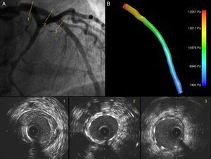 Angiography showing a good angiographic result after PCI of the LAD (A); IVUS images show good expansion and correct stent apposition (2, 3). The LAD ostium is preserved; (B) 3D IVUS reconstruction of the LAD with pressure gradients obtained through CFD showing a reduction in pressure drop after PCI.