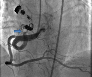 Total occlusion of the fistula before the proximal coil (arrow) seen on the control angiogram, left anterior oblique cranial view.