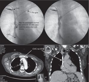 Em cima: tentativa de implantação de pacemaker na primeira doente, A. A., através de punção subclávia esquerda, não se tendo conseguido prosseguir com o guia. A doente apresentava cateter venoso central (CVC) à direita. Após administração de contraste, verificou‐se obstrução da veia cava superior. Em baixo: imagens de angio‐TAC em que se visualiza o cateter venoso central na transição entre a veia cava superior (VCS) e a aurícula direita, aparentemente aderente à VCS, que apresenta calibre reduzido, o que, combinado com a circulação colateral visível sugere fibrose parietal da veia cava superior sequelar.