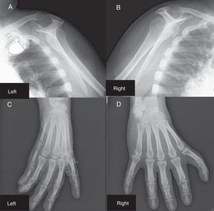 Shoulder girdle X-ray showing hypoplasia of the glenoid cavity and bilateral degenerative changes of the gleno-humeral joints (A and B); X-ray showing syndactyly between the first and second axes of the left hand and wrist; the trapezium and trapezoid cannot be differentiated (C); right hand with morphological changes of the proximal carpal row; the first finger of the right hand is morphologically similar to the others (D).