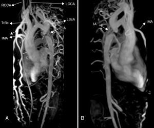 Three-dimensional volume rendering magnetic resonance angiography images: (A) left posterior oblique view and (B) right posterior oblique view, showing interruption of the descending aorta after the branching of the left subclavian artery. IA: interrupted aorta; IMA: internal mammary artery; LCCA: left common carotid artery; LSCA: left subclavian artery; RCCA: right common carotid artery; TrBc: truncus brachiocephalicus.