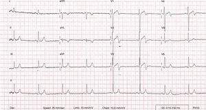 12-lead electrocardiogram showing T-wave inversion in leads AVL and V1–V4.