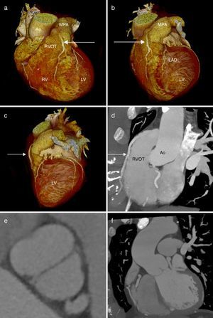 (a–c) Three-dimensional volume rendered cardiac computed tomography images showing the relationship of the coronary artery fistula (arrow) to the right ventricular outflow tract, aorta and main pulmonary artery in anterior (a), anterolateral (b) and lateral (c) planes; (d) curved multiplanar reformatted cardiac computed tomographic image showing the course of the coronary artery fistula anterior to the right ventricular outflow tract; (e) multiplanar reformatted cardiac computed tomographic image showing the presence of a non-calcified bicuspid aortic valve; (f) curved multiplanar reformatted cardiac computed tomographic image showing the presence of a concomitant aortopathy. Ao: aorta; LAD: left anterior descending coronary artery; LV: left ventricle; MPA: main pulmonary artery; RVOT: right ventricular outflow tract.