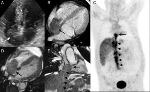 (A) Apical 4-chamber echocardiographic view, showing preserved biventricular function, but a large irregular mass inside the right atrium (arrow); (B) computed tomography, 4-chamber view, showing patchy contrast uptake inside the right atrial mass (arrow); (C) positron emission tomography, coronal view, showing pathological uptake of 18-fluoro-deoxy-glucose in the mass (arrow), extending along the inferior vena cava (arrowheads), suggesting a neoplastic nature with variable retrograde thrombotic apposition; (D and E) cardiovascular magnetic resonance image of the neoplastic mass occupying most of the right atrium (D, 4-chamber cine view) and extending along the inferior vena cava (E, parasagittal cine view).