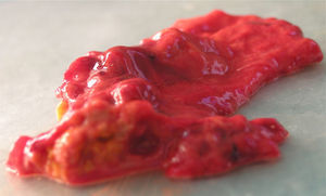 Macroscopic autopsy specimen of the inferior vena cava (after removal of the large intravascular thrombus), showing an irregular tissue mass growing from the vessel wall; immunohistochemistry study identified the growth as a leiomyosarcoma (positive for smooth muscle actin, desmin and vimentin).