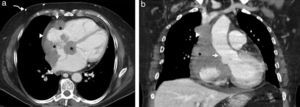 Axial (a) and coronal reconstructed (b) images from non-ECG-gated enhanced computed tomography, at presentation. A primary cardiac lymphoma (asterisks, a, b) extends through the atrioventricular groove, the right atrial chamber and interatrial septum (asterisks). The patency of the right coronary artery (arrow, a) is preserved. A mild pericardial effusion is present (arrowhead, a) and superficial collateral circulation is shown (curved arrows, a). Coronal reconstructed images better illustrate the sparing of the aortic root (arrow, b) and obstruction of the superior vena cava (arrowhead, b).
