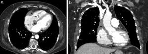 Axial image (a) and coronal reconstructed (b) images from non-ECG-gated enhanced computed tomography, after three months of chemotherapy. The decrease in size of the primary cardiac lymphoma mass can be seen (asterisks, a, b). Note the pacing leads in the right chambers (arrows, a, b).