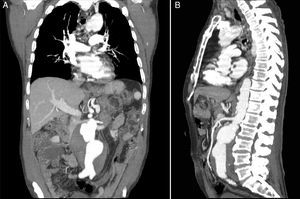 Contrast-enhanced computed tomography image of the abdominal aortic aneurysm in coronal view (A) and sagittal view (B).