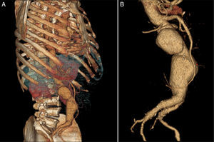 Three-dimensional computed tomography reconstruction of the abdominal aortic aneurysm (A) and corresponding volume-rendered angiography in detail (B).