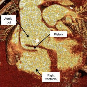 Three-dimensional computed tomography angiography showing a fistula between the aortic root and right ventricle.
