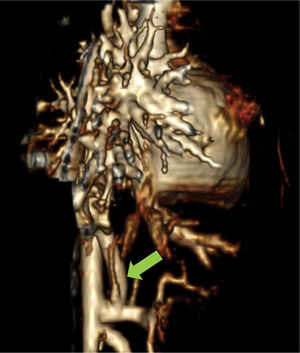 AngioTAC – reconstrução 3D. Seta verde→MAPCA a sair do tronco celíaco.