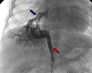 Angiografia na artéria aorta: visualiza‐se (seta vermelha) MAPCA gigante a sair da aorta e a vascularizar os segmentos inferiores do pulmão direito. Visualiza‐se também (seta azul) drenagem venosa para a veia pulmonar inferior direita.