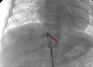 Angiografia na artéria aorta (após procedimento): visualiza‐se (seta vermelha) Amplatzer (10‐7 PLUG II) colocado na MAPCA.