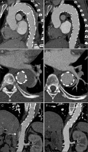 Imagens da angioTC realizada imediatamente após a TEVAR (A, B e C) e da angioTC de controlo seis meses após o tratamento (D, E e F). Observam‐se as duas endopróteses aórticas parcialmente sobrepostas, recobrindo o IMH e o canal arterial, desde a artéria subclávia esquerda até ao início da aorta abdominal, sem evidência de endoleaks (A). Na figura C, a imagem de DAo distalmente à prótese (seta), com origem ao nível do tronco celíaco e estendendo‐se até à artéria mesentérica superior. Comparativamente à angioTC pós‐procedimento, na angioTC de controlo aos seis meses observa‐se uma regressão quase total do IMH (D e E) e o desaparecimento da imagem de DAo abdominal (F).
