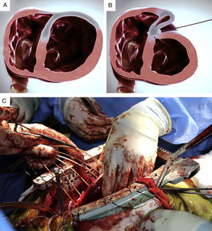 (A and B) LIVE technique, consisting of plication of the LV scar through a series of epicardially delivered anchor pairs that pull the LV free wall to the septum; (C) intraoperative image of plication of the large anteroapical aneurysm.
