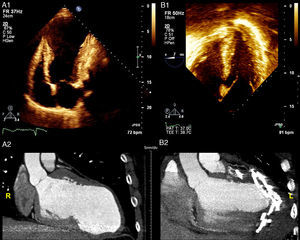 (A1) Baseline transthoracic echocardiogram in 4-chamber view showing the large LV aneurysm and preserved basal segments; (A2) cardiac computed tomography (CT) scan before the procedure to assess the possibility of percutaneous treatment; (B1) intraoperative transesophageal echocardiogram showing normalization of ventricular shape and reduction of LV volume; (B2) cardiac CT scan post-procedure showing the anchor pairs and absence of contrast leakage between the excluded scar and the LV.