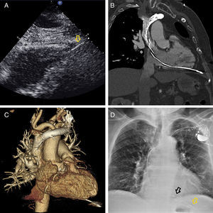 (A) Transthoracic echocardiography, subcostal view, showing the pacemaker lead perforating the right ventricle (arrow); (B) and (C) cardiac computed tomography showing the entire pacemaker lead and the perforation through the right ventricle; (D) chest X-ray at discharge showing the two leads (arrows). Black arrow: new lead, yellow arrow: old lead perforating the cardiac wall.