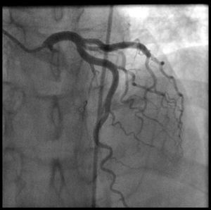 Cardiac catheterization showing normal left coronary artery.