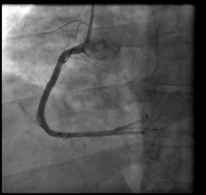 Cardiac catheterization showing normal right coronary artery.