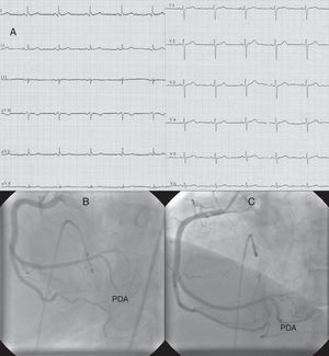 (A) ECG at first admission; (B) right coronary angiography during first myocardial infarction showing total occlusion of the mid portion of the posterior descending artery (PDA); (C) right coronary angiography during first myocardial infarction after percutaneous coronary intervention to the PDA.