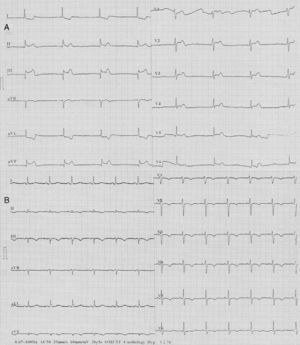 (A) ECG during second myocardial infarction; (B) ECG after recurrent ischemic events.