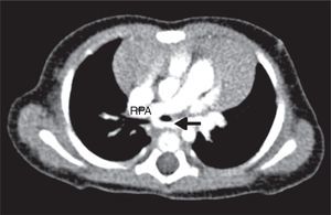 Computed tomographic angiography reveals anomalous origin of the LPA from the posterior aspect of the RPA. The aberrant LPA (black arrow) runs behind the trachea as it courses to the left pulmonary hilum, causing a mild compression of the origin of the LPA.