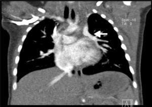Computed tomographic angiography reveals partial anomalous pulmonary venous return consisting of left superior pulmonary vein (white arrow) draining in the left brachiocephalic vein.