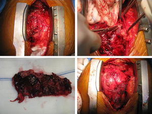 Imagem intraoperatória, mostrando o aspeto macroscópico do pericárdio sugestivo de infiltração tumoral e sínfise pericárdica completa.