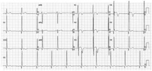 ECG of healthy male athlete of African origin, showing increased QRS voltage, convex ST-segment elevation and deep T-wave inversion in V1–V4 (courtesy of Cardiovascular Sciences Research Centre, St. George