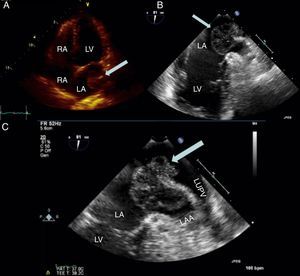 (A) Transthoracic echocardiography, 4-chamber view, showing a large mass attached to the lateral wall of the left atrium (arrow); (B and C) transesophageal echocardiography, modified 2-chamber views, showing a large mass attached to the coumadin ridge with a broad stalk (B) and protruding into the left atrial appendage during atrial systole (C) (arrows). LA: left atrium; LAA: left atrial appendage; LUPV: left upper pulmonary vein; LV: left ventricle; RA: right atrium; RV: right ventricle.