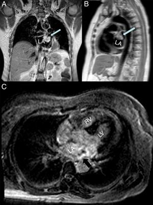 (A and B) Cardiac magnetic resonance (CMR) imaging, coronal T1-weighted (A) and sagittal T2-weighted (B) sequences, revealing the high signal intensity of the left atrial mass (arrow); (C) CMR late enhancement image identifying a hyperintense mass (arrow). LA: left atrium; LV: left ventricle; RV: right ventricle.