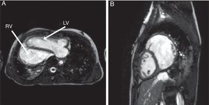 Cardiac MRI (balanced SSFP cine images) showing (A) apex to the RV and LV anterior to the RV; (B) LV anterior to the dilated RV.