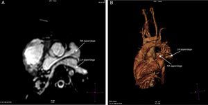 (A) Cardiac MRI (balanced SSFP cine images), axial view, showing juxtaposed RAA on the left side: RAA has triangular shape and LAA has tubular shape. (B) 3D-balanced SSFP volume rendered view showing left juxtaposition.