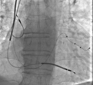 Angiogram showing dislodgement of the J-shaped passive fixation atrial lead to the superior vena cava.