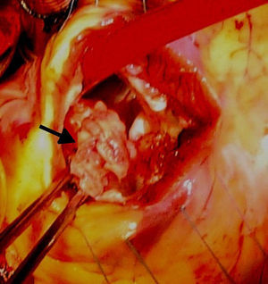 Imagem intraoperatória da válvula pulmonar com vegetações (seta).