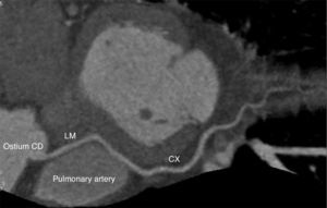 Interarterial course of the left main between the pulmonary artery and the aorta. Cx: circumflex artery; LM: left main; Ostium CD: right coronary artery ostium; RCA: right coronary artery.