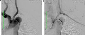 Aortografia revelando estenose da artéria subclávia esquerda (1A) e preenchimento retrógrado pela artéria vertebral homolateral (1B).