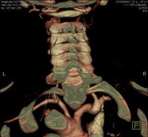 TC com contraste: reconstrução posterior dos vasos supra‐aórticos, notando‐se ausência de preenchimento da emergência da artéria subclávia esquerda com preenchimento retrógrado pela artéria vertebral esquerda.
