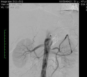 Angiografia da aorta abdominal revelando estenoses pré‐oclusivas das artérias renais esquerda e direita.