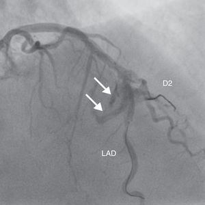 Coronary angiography showing class III perforation (perforation ≥1 mm in diameter with contrast streaming or cavity spilling) after balloon inflation at high pressure. D2: second diagonal branch; LAD: left anterior descending artery.