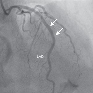 Coronary angiogram after stent graft implantation showing sealing of the LAD rupture area and loss of the second diagonal branch (arrows). LAD: left anterior descending artery.