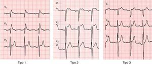 Padrão eletrocardiográfico de Brugada tipo 1, 2 e 3.