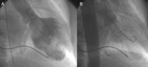 Cardiac catheterization showing the ventriculogram: (A) diastole, (B) systole with severe apical hypokinesis.